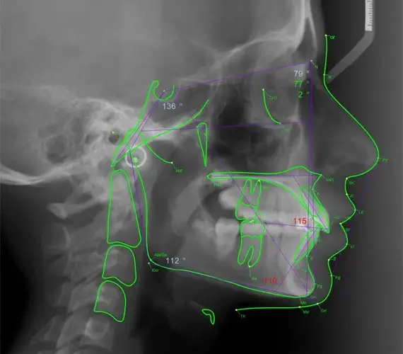 Traced cephalometric radiograph from a Lonehill Orthodontics referral report
